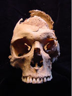 Anterior View of Skull Excavated from Hrisbrú Churchyard