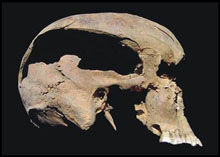 Lateral View of Skull Excavated from Hrisbrú Churchyard With Massive Wound from Axe Blow